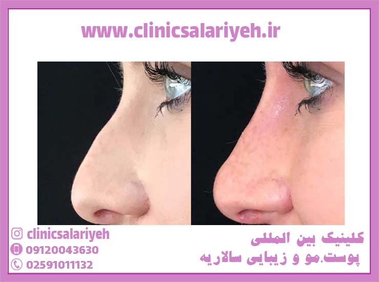 عکس لیفت بینی با نخ چقدر است؟ - کلینیک پوست و مو زیبایی سالاریه قم